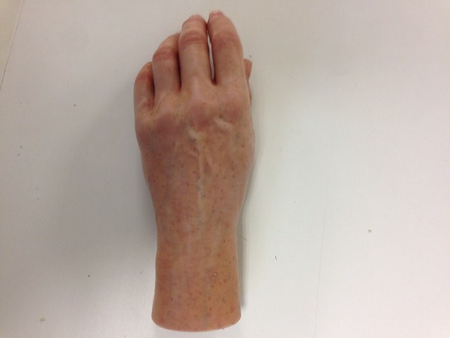 Fabrication prothèse de main esthétique Arras (62)
